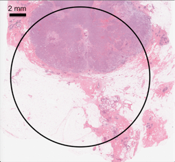 Breast tumor histology ROI